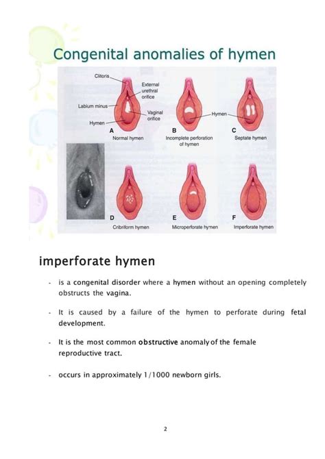 imperforate hymen|Diagnosis and Management of Hymenal Variants